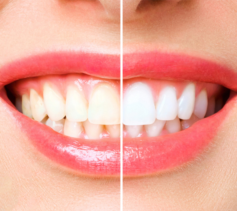 Teeth-Whitening-2 Dr. Peter Servinis