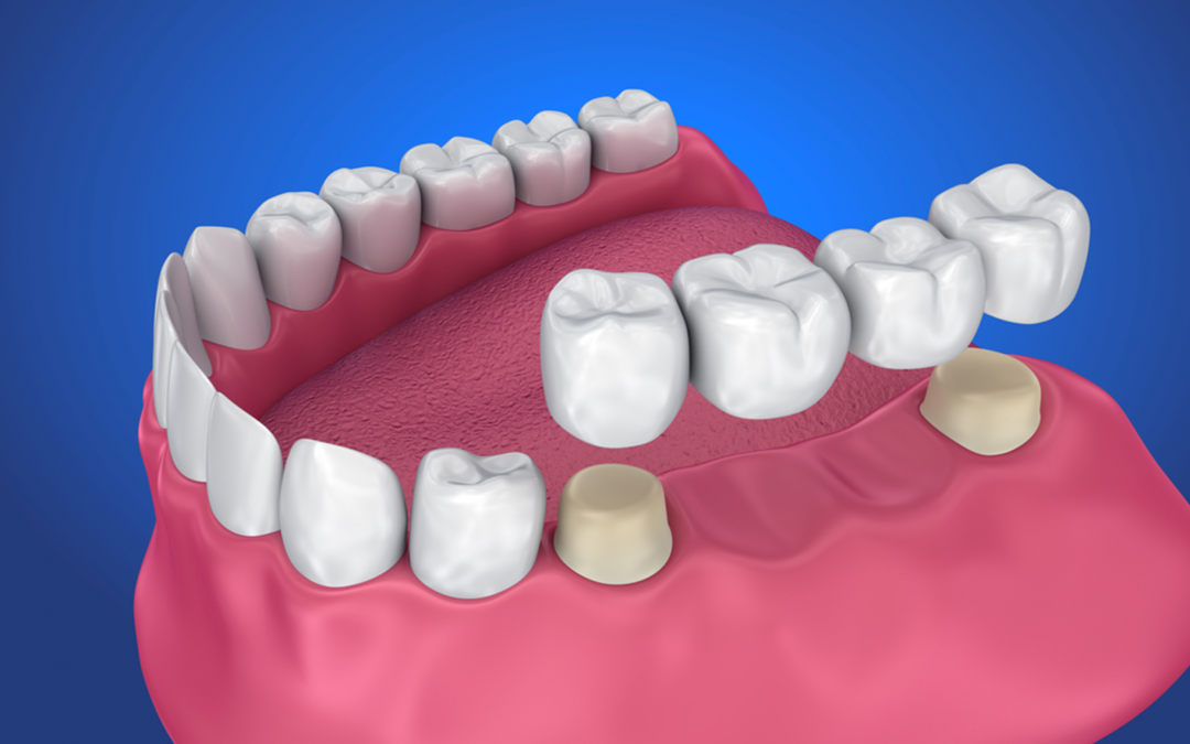 What You Need To Know About Dental Bridges