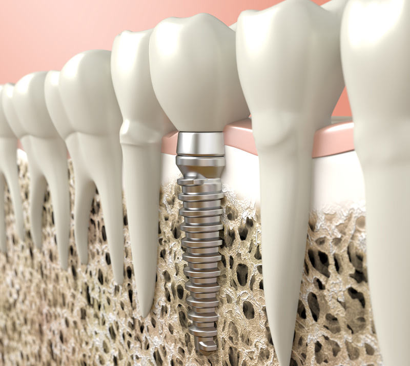all on four dental implants in barrie