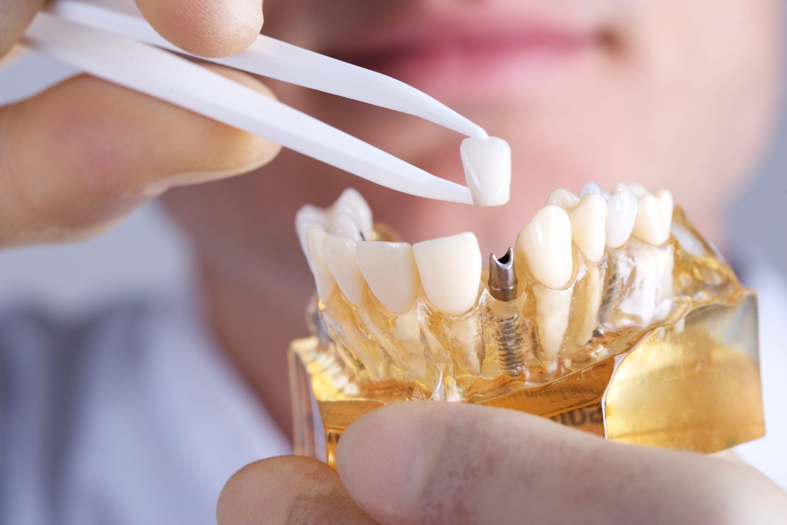 dental implants in barrie