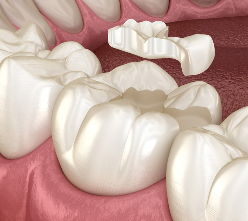dental inlays and onlays near you