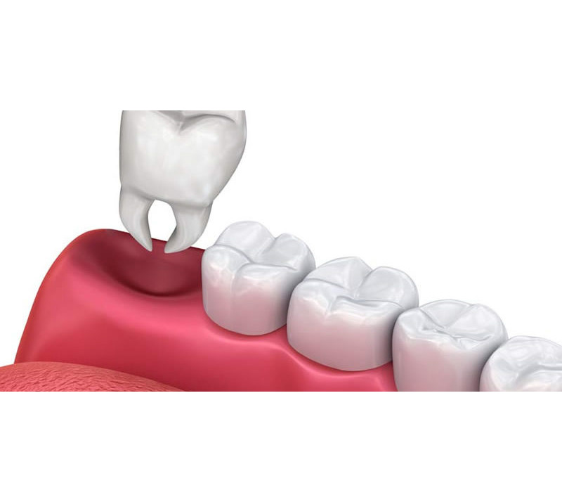 teeth extractions in barrie