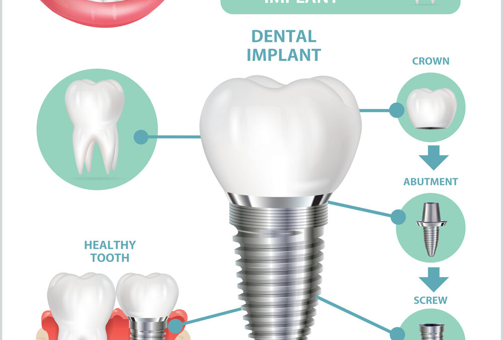 Why Choose Dental Implants as Your Long-Lasting Tooth Replacement
